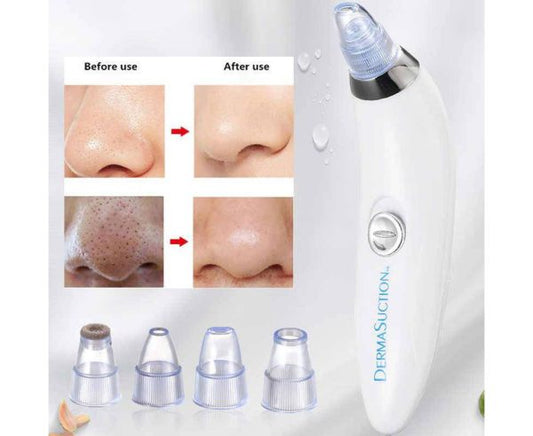 Blackhead Remover | Vacuum Pore Cleaner | 4-in-1 Suction Tool | Acne & Dead Skin Extractor
